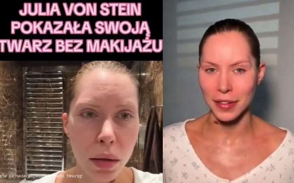 Julia von Stein ostrzega przed operacjami plastycznymi. Twierdzi, że teraz nie może się uśmiechać i musi przejść kolejną operację Zdjęcie wpisu