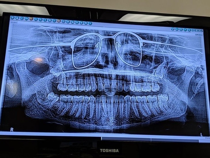 2. Zdjęcie panoramiczne szczęki. Pacjent zapomniał zdjąć okulary