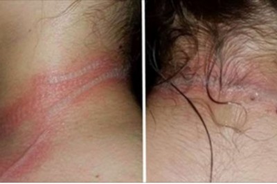 13-latka zbiega po schodach krzycząc z bólu zakrywa poparzoną szyję! Matka nie była w stanie jej pomóc! 