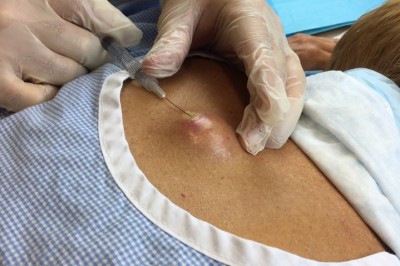 5 milionów widzów udowadnia, że ludzie uwielbiają to oglądać! Wyciskanie wielkiej cysty z pleców pacjenta!