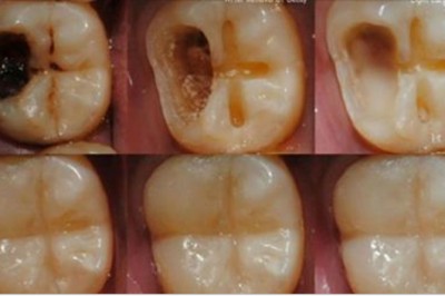 5 łatwych kroków które pozwolą Ci uzdrowić Twoje zęby i zapomnieć o ubytkach! To łatwiejsze niż myślisz! 
