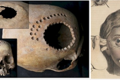 9 przerażających zabiegów lekarskich z przeszłości które dziś szokują! 