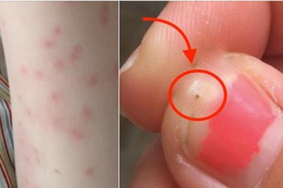 Ciało jej córki pokrywały małe ciemne kropki! Przerażona mama naliczyła na jej skórze 150 larw kleszczy! 