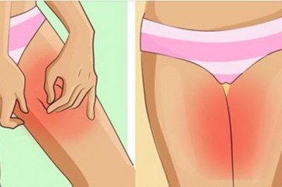 Dzięki tym 7 trikom zapomnisz o obtarciach ud w upalne dni! Twoje nogi Ci podziękują! 