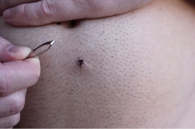 Jak on mógł to wyhodować?! Wyciąganie najdłuższego wrośniętego włosa jaki kiedykolwiek widziałam!