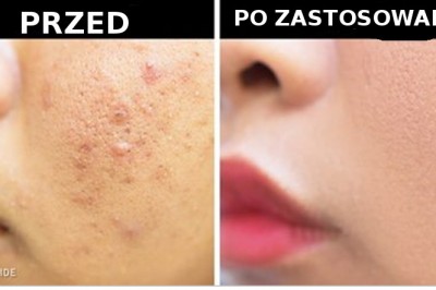 Jeden naturalny składnik by uzyskać idealną skórę i włosy! Każdy ma go w swoim domu!