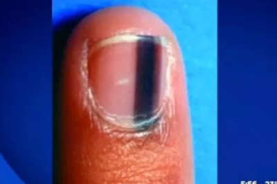 Jeśli zauważysz na swoich paznokciach takie zmiany, NATYCHMIAST udaj się do lekarza! 