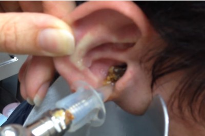 Lekarz nie mógł uwierzyć co wyciąga! Takiego efektu płukania ucha się nie spodziewali! 