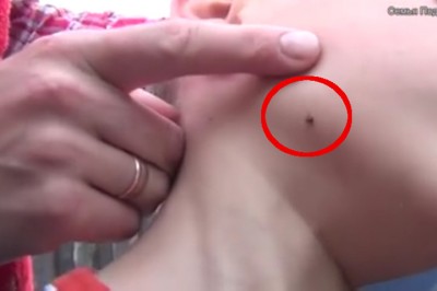 Mama zobaczyła wbitego kleszcza w buzie swojego dziecka! Sposób w jaki go wyciągnęła jest genialny! 