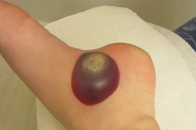 Musieli ją zamrozić ciekłym azotem! Usuwanie największej kurzajki może przeprawić o dreszcze!