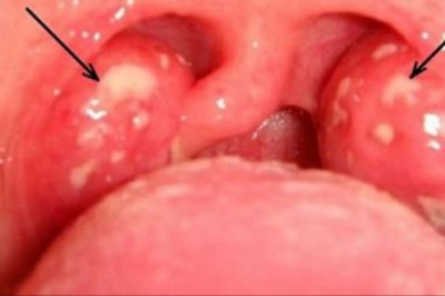 Męczy Cię ból gardła? Wylecz go w jeden dzień bez żadnych antybiotyków! Naturalne metody mają moc! 