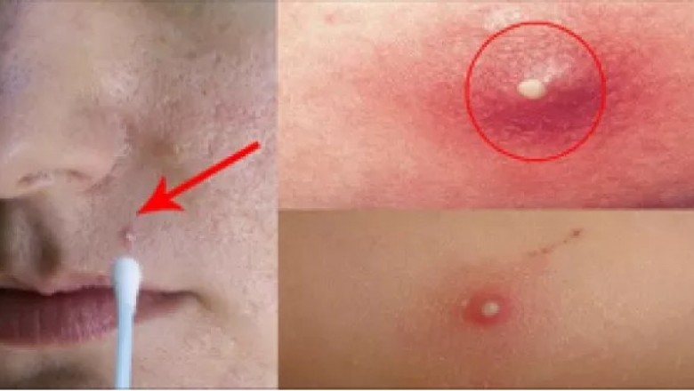 Najlepszy sposób by pozbyć się uciążliwych pryszczy! Masz wszystkie składniki w domu!
