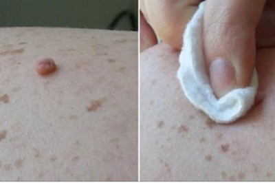 Nasączyła wacik octem jabłkowym i przecierała codziennie pieprzyka! Po kilku dniach efekt przeszedł oczekiwania!