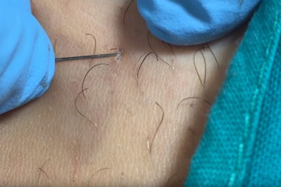 Nienawidzi tego każda kobieta! Usuwanie wrośniętych włosków w okolicach bikini! 