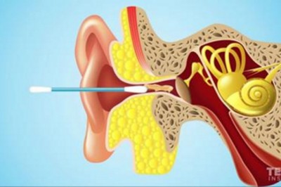 Po obejrzeniu tego nigdy już nie użyjesz patyczków do czyszczenia uszu! Nie wiedziałam, że mogą być niebezpieczne! 