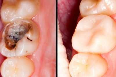 Pozbądź się próchnicy i zapobiegaj dziurom w zębach w 5 prostych krokach! Naturalna metoda! 