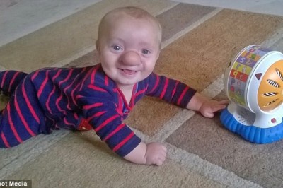 Prawdziwy Pinokio! Niesamowita historia chłopca któremu ciągle rósł nosek! 