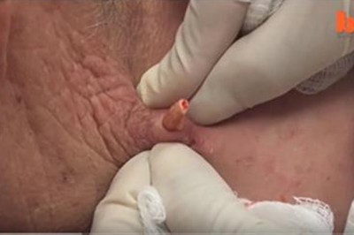 Przyszła do lekarza ze zwykłym pryszczem! Jednak okazało się, że problem był o wiele większy!