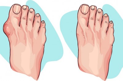Te 5 produktów pomoże Ci zmniejszyć haluksy! Dodatkowo niwelują uporczywy ból stopy! 