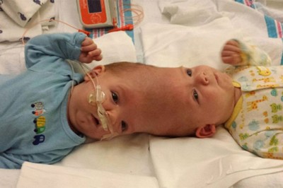 Te bliźniaki syjamskie urodziły się zrośnięte głowami! To jak wyglądają po 27 godzinnej operacji to cud! 