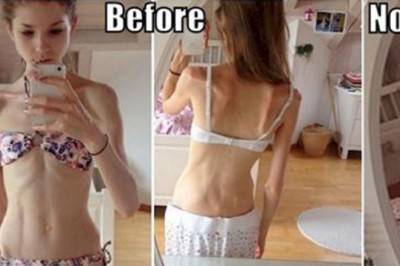 Ważyła 22 kilogramy i byłą na skraju śmierci! Miłość jej chłopaka pozwoliła odzyskać normalny wygląd!