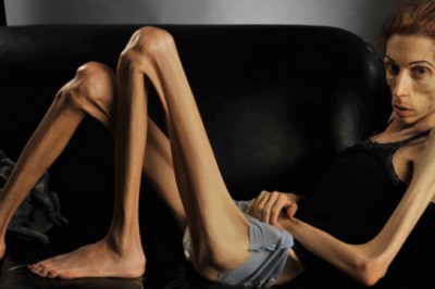 Ważyła zaledwie 20 kg i była na skraju śmierci! Zobacz jak wygląda teraz dzięki pomocy ludzi!