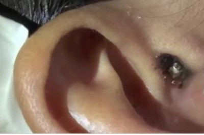 Zakropiła kilka kropel wody na jego ucho! To co wyszło ze środka jest po prostu przerażające!