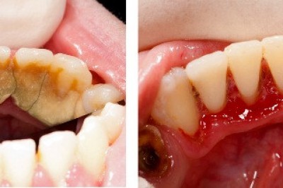 Zostań własną dentystką! Domowy sposób na usunięcie płytki nazębnej! Odzyskaj biały uśmiech!