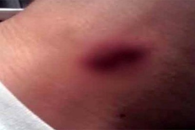 Zrobiła namiętną malinkę swojemu chłopakowi na szyi! Dzień później chłopak umiera, a wina spada na nią!