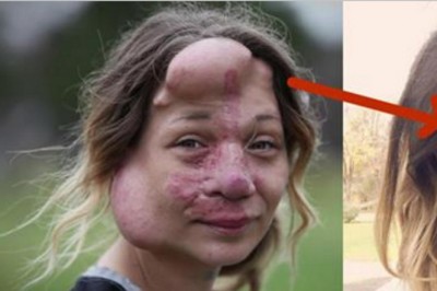 Żeby ratować jej życie musieli odciąć jej nos! To jak wygląda po operacji jest naprawdę niezwykłe! 