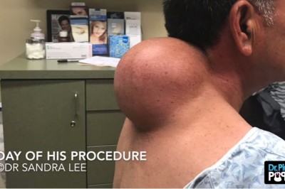 Ta narośl na plecach miała wielkość grejpfruta! Zabieg usuwania może przyprawić o dreszcze! 