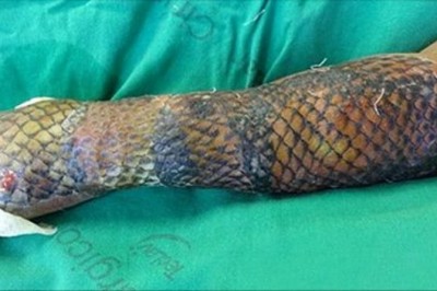 Jej ręce i nogi były pokryte rybią łuską przez 3 tygodnie! Gdy lekarze ją ściągają są zaskoczeni rezultatem!