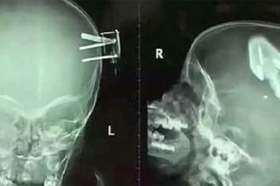 Skaczące dziecko spada z łóżka i uszkadza czaszkę! To co zobaczyli lekarze na prześwietleniu szokuje! 