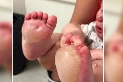  Mama widzi pęcherze na stopach córeczki! Jak zrozumiała co zrobiła opiekunka wpadła w furię!