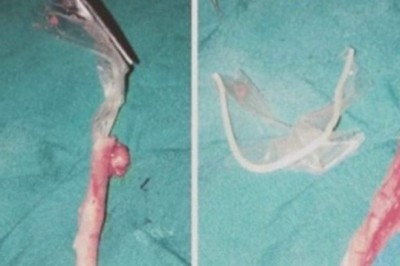 Strasznie bolał ją brzuch! Kiedy lekarze otworzyli jej jelito i zobaczyli powód, niewierzyli własnym oczom