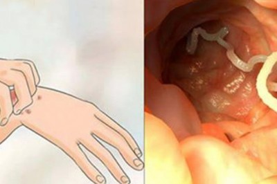 To są objawy, które mogą wskazywać, że w Twoim ciele zagnieździły się pasożyty! Zobacz jak się ich pozbyć!