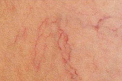 Lekarstwo na nieestetyczne pajączki na nogach masz w swoich domu! Mało kto wie jak je użyć!