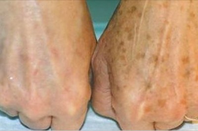 Przetestuj ten bardzo prosty sposób na usunięcie przebarwienia ze skóry! Działa!