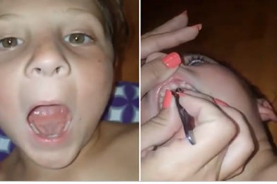 Syn skarżył się na ból dziąseł! W jego ustach mam znalazła wrośnięte 32 paznokcie! 