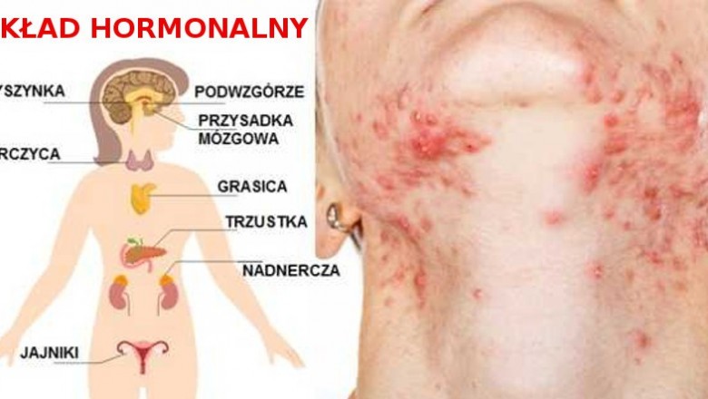 Te produkty spożywcze destrukcyjnie wpływają na Twój układ hormonalny i cerę! Unikaj ich w sklepie!