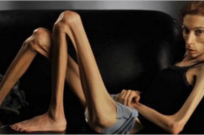 Ważyła jedynie 20 kg i była na skraju śmierci! Dzięki pomocy ludzi zmieniła się nie do poznania!