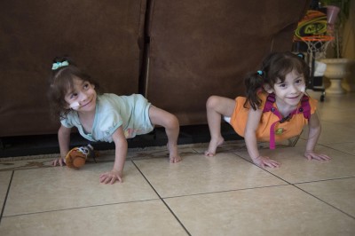 Urodziły się zrośnięte i dawano im małe szanse na przeżycie! Lekarze podjęli się 18 godzinnej operacji! 