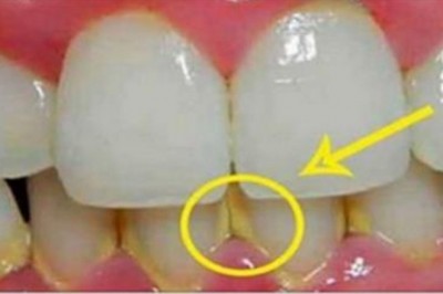 Przeczytaj jak usunąć kamień z zębów w 5 minut naturalnymi składnikami! Bez wizyty u dentysty!