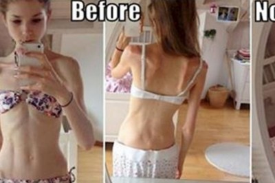 Jak ważyła 22 kilogramy była na skraju śmierci! Miłość pozwoliła jej odzyskać normalny wygląd!