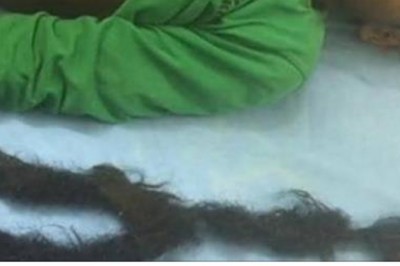 Miał tak ostre bóle brzucha, że w końcu musiał być operowany!  Po 3 godzinach wyciągnęli z niego żerującego brata bliźniaka!