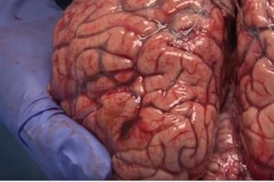 Neurobiolog pokazuje jak wygląda świeżo wyjęty z czaszki ludzki mózg! Zaskakujące jak bardzo jest delikatny! 