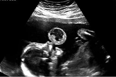 Mama myślała, że na USG widać jak jej maluch puszcza bańki! Wtedy lekarz przekazuję jej złe nowiny!