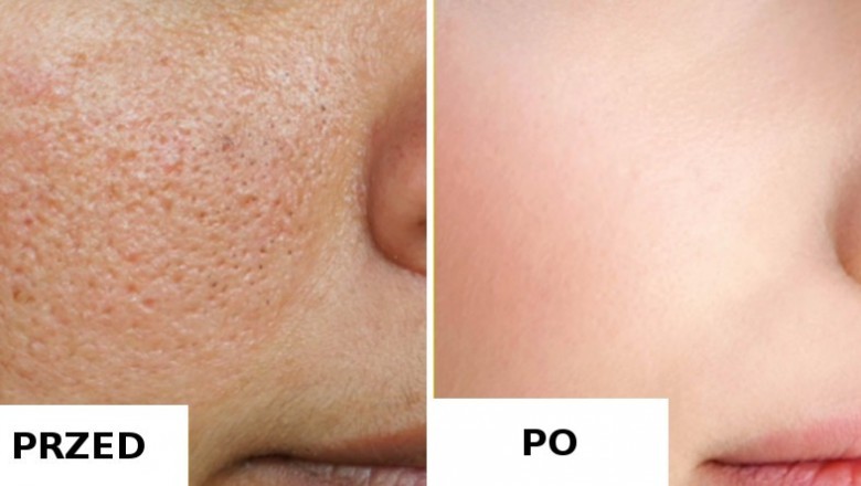 4 naturalne sposoby, żeby pozbyć się otwartych porów z twarzy! Skóra znów będzie nieskazitelna