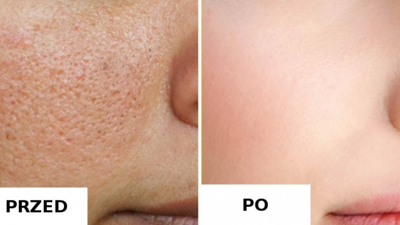 4 naturalne sposoby, żeby pozbyć się otwartych porów z twarzy! Skóra znów będzie nieskazitelna!