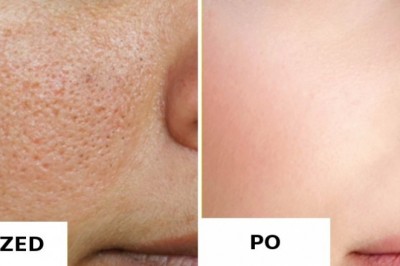 4 naturalne sposoby, żeby pozbyć się otwartych porów z twarzy! Skóra znów będzie nieskazitelna!